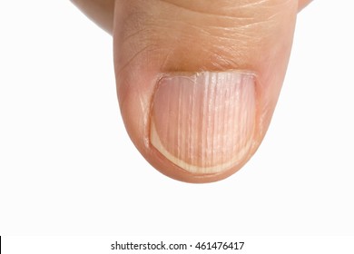 Vertical ridges on the fingernails symptoms deficiency  vitamins and minerals