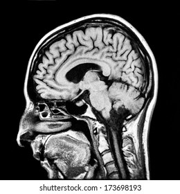 Vertical Section Of Human Brain MRI Scan