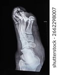 Vertical X-ray with toe dislocations. Hook-shaped deformity of the finger. Lisfranc joint, Foot fractures.