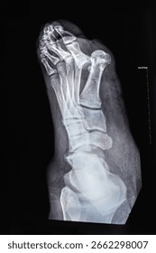 Vertical X-ray with toe dislocations. Hook-shaped deformity of the finger. Lisfranc joint, Foot fractures.