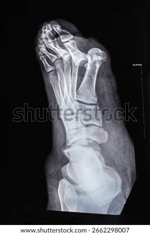 Vertical X-ray with toe dislocations. Hook-shaped deformity of the finger. Lisfranc joint, Foot fractures.