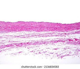 Very low magnification micrograph showing the wall of a large vein. The muscular layer is very thin. Almost the entire wall corresponds to the adventitia layer, rich in bundles of collagen fibers.