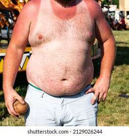 A very sunburnt overweight man stands in a field. He has a bare hairy chest that is white and the clear red angry burn outline of a vest. Looks like a T-shirt with dangerous sunburn to arms and neck 