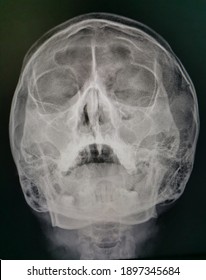 X​-ray​ ​image​, Paranasal​ ​sinus​  caldwell​ and​ water​ view.