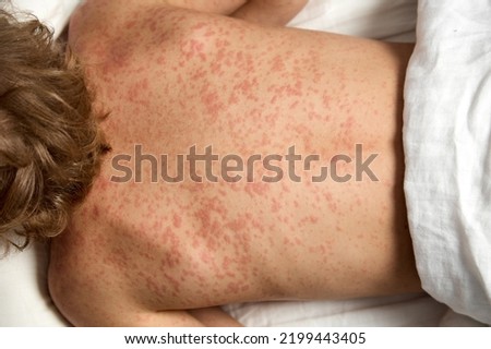 View from above the back of a child suffering from exacerbation of atopic dermatitis on the body. Severe allergic rash covered the body of a little boy