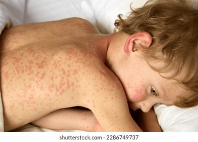 View from above of a sad boy lying on a bed, courageously enduring an unpleasant illness. The child has rubella, lies in bed, rash all over the body