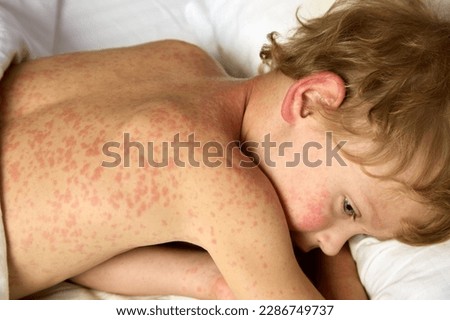 View from above of a sad boy lying on a bed, courageously enduring an unpleasant illness. The child has rubella, lies in bed, rash all over the body