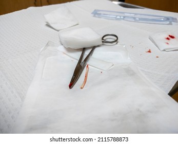 View Of A Birth Control Arm Implant, Freshly Removed, Sitting On A Medical Table With Some Gauze