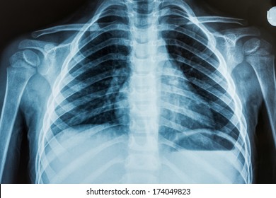 Просмотр детской рентгеновской пленки, взятой для обследования легких