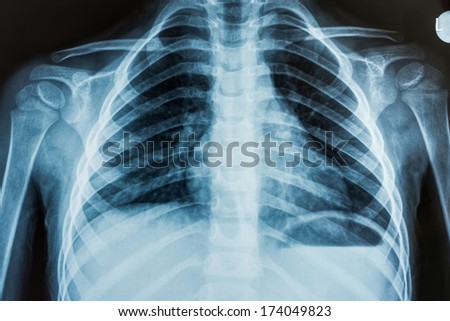 View of a child x-ray film, taken to examine the lungs