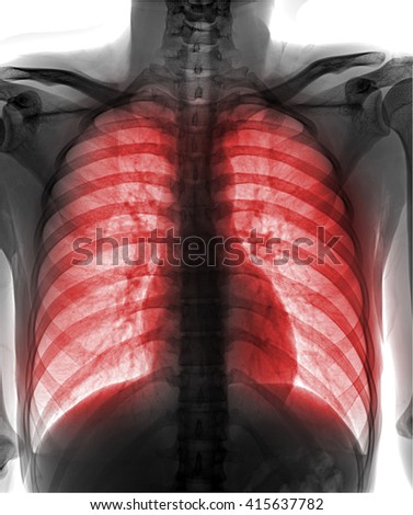 View of a human x-ray film, taken to examine the lungs on white background