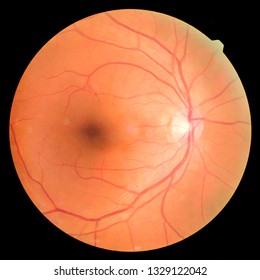 View inside human eye disorders - showing retina, optic nerve and macula.Retinal picture ,Medical photo tractional (eye screen) retinal detachment of diabetes.