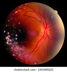 View inside human eye disorders, optic nerve and macula.Retinal picture ,Medical photo tractional (eye screen) retinal detachment of diabetes.Eye treatment concept.select focus.
