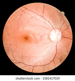 View Inside Human Eye Disorders - Showing Retina, Optic Nerve And Macula.Medical Photo Tractional (eye Screen) Retinal Detachment Of Diabetes.select Focus.