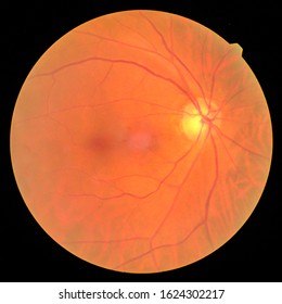 View Inside Human Eye Disorders - Showing Retina, Optic Nerve And Macula.Medical Photo Tractional Retinal Detachment Of Diabetes.Eye Treatment Concept.select Focus.