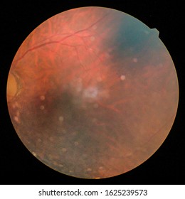 View inside human eye disorders - showing retina, optic nerve and macula.Medical photo tractional retinal detachment of diabetes.Eye treatment concept.select focus.