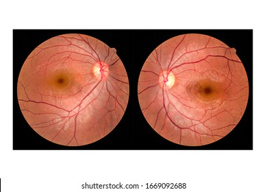 View inside human eye disorders - showing retina, optic nerve and macula.Retinal picture ,Medical photo tractional (eye screen) retinal detachment of diabetes.Eye treatment concept.