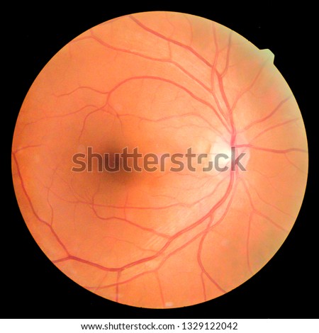View inside human eye disorders - showing retina, optic nerve and macula.Retinal picture ,Medical photo tractional (eye screen) retinal detachment of diabetes.