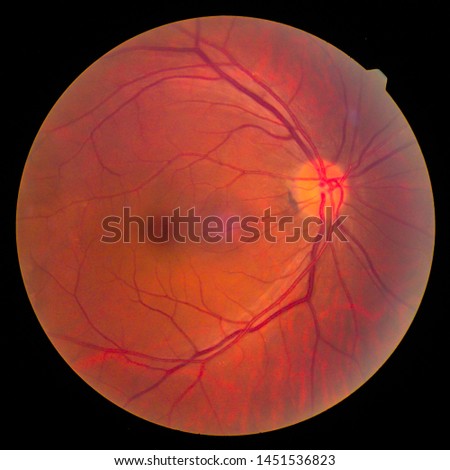 View inside human eye disorders - showing retina, optic nerve and macula.Retinal picture ,Medical photo tractional (eye screen) retinal detachment of diabetes.Eye treatment concept.