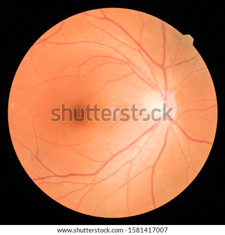 View inside human eye disorders - showing retina, optic nerve and macula.Medical photo tractional (eye screen) retinal detachment of diabetes.select focus.