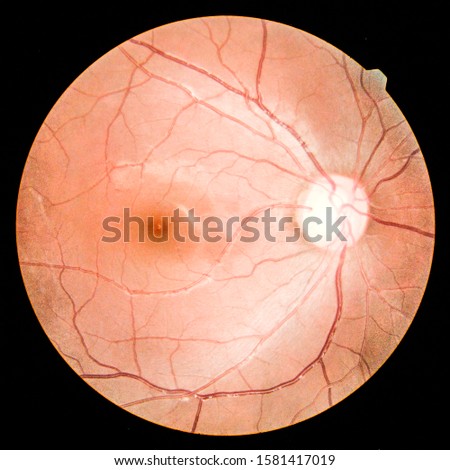 View inside human eye disorders - showing retina, optic nerve and macula.Medical photo tractional (eye screen) retinal detachment of diabetes.select focus.