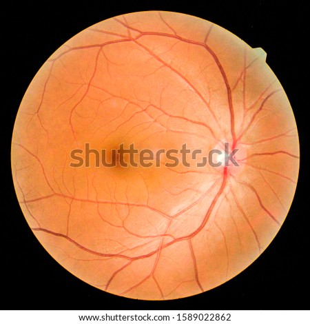 View inside human eye disorders - showing retina, optic nerve and macula.Medical photo tractional (eye screen) retinal detachment of diabetes.select focus.