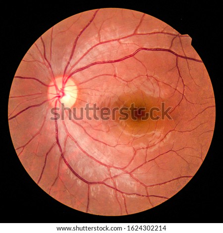 View inside human eye disorders - showing retina, optic nerve and macula.Medical photo tractional retinal detachment of diabetes.Eye treatment concept.select focus.