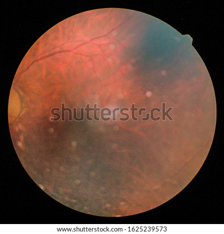 View inside human eye disorders - showing retina, optic nerve and macula.Medical photo tractional retinal detachment of diabetes.Eye treatment concept.select focus.