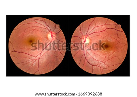 View inside human eye disorders - showing retina, optic nerve and macula.Retinal picture ,Medical photo tractional (eye screen) retinal detachment of diabetes.Eye treatment concept.