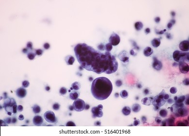 View In Microscopic Of Abnormal Cells Criteria For Adenocarcinoma.Pap Smear For Woman.Medical Background Concept.