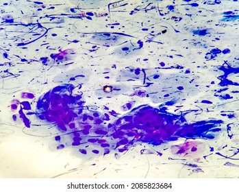 View In Microscopic Of Abnormal Cells..Pap Smear For Woman.Medical Background Concept.