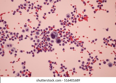 View in microscopic of abnormal cells.Pap smear for woman.Medical background concept.
