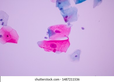 View Microscopic Abnormal Human Cervix Cellssquamous Stock Photo ...