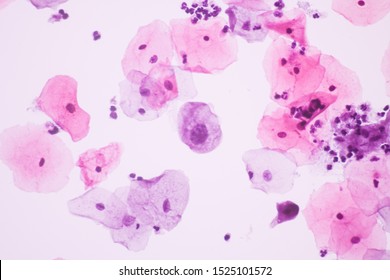 View in microscopic of Abnormal human cervix cells.Squamous epithelium cells.Superficial and intermediate epithelial cells.Cytology and pathology laboratory department.Magnification 600 X