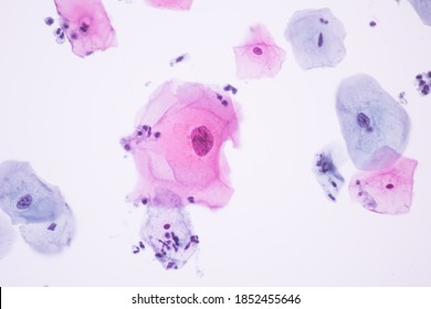 View Microscopic Abnormal Human Cervix Cellssquamous Stock Photo ...