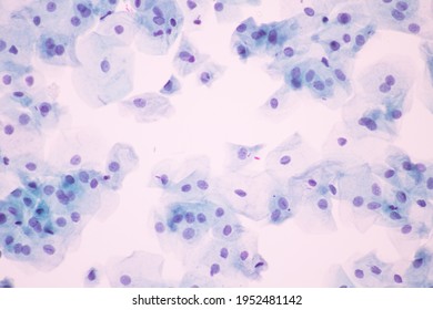 View Microscopic Abnormal Human Cervix Cellssquamous Stock Photo ...