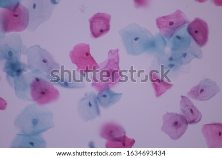 View in microscopic of Abnormal human cervix cells.Squamous epithelium cells.Superficial and intermediate epithelial cells.Cytology and pathology laboratory department.Magnification 600 X