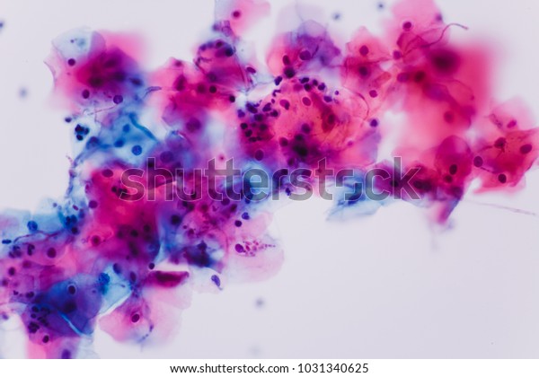 View in microscopic of Candidiasis, fungus\
infection (Yeast and Pseudohyphae form) in pap smear slide cytology\
and diagnostic by pathologist.Gynecology report and\
diagnosis.Medical concept.