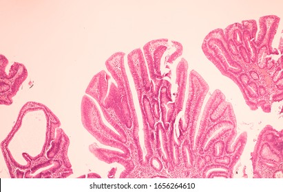 View In Microscopic Of Ductal Cell Carcinoma, Adenonocarcinoma From Human Breast Cancer, Tissue Section By H And E Stain.Pathology Diagnosis.Medical Concept. Under Microscope, Magnification 100X