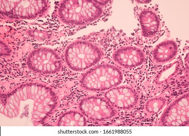 View In Microscopic Of Ductal Cell Carcinoma, Adenonocarcinoma From Human Breast Cancer, Tissue Section By H And E Stain.Pathology Diagnosis.Medical Concept. Under Microscope, Magnification 600X