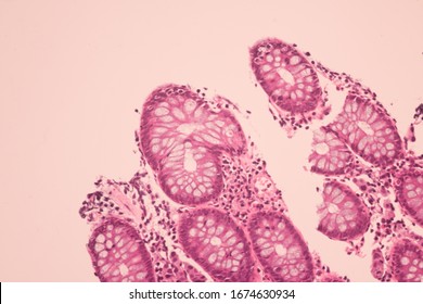 View In Microscopic Of Ductal Cell Carcinoma, Adenonocarcinoma From Human Breast Cancer, Tissue Section By H And E Stain.Pathology Diagnosis.Medical Concept. Under Microscope, Magnification 600X