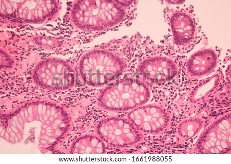 View in microscopic of ductal cell carcinoma, adenonocarcinoma from human breast cancer, tissue section by H and E stain.Pathology diagnosis.Medical concept. Under microscope, magnification 600X