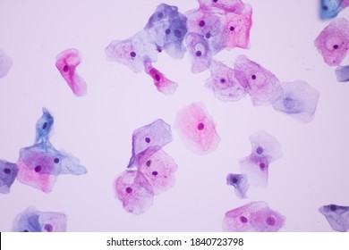 squamous papilloma cytology