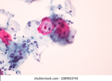 View In Microscopic Koilocyte Cell Criteria Of HPV (Human Papilloma Virus) Infection.Pap Smear For Woman.Cevical Cancer Screening.Medical Background Concept.