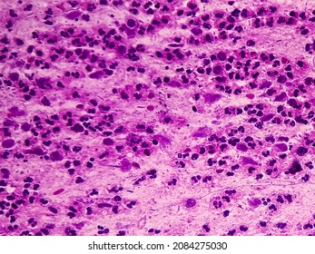 View In Microscopic Koilocyte Cell Criteria Of HPV (Human Papilloma Virus) Infection.Pap Smear For Woman.Cevical Cancer Screening.Medical Background Concept.