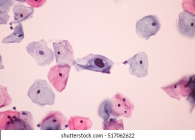 View In Microscopic Of Koilocyte Cell Criteria Of HPV Infection.Abnormal Squamous Epithelial Cells.Pap Smear For Woman.Medical Background Concept.