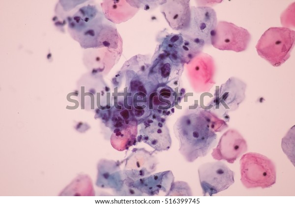 View in microscopic of koilocyte cell criteria
of HPV (Human Papilloma virus) infection.Pap smear for
woman.Medical background
concept.