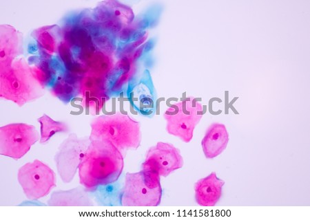 View in microscopic koilocyte criteria of Human Papilloma Virus (HPV) infection from pap smear cytology slide.Medical concept background.