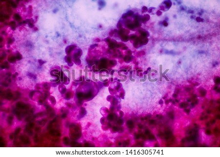 View in microscopic of malignat human cells in non gyanae cytology slide background.Tumor cell in pleural effusion.Cytology and pathology laboratory department.600 X.