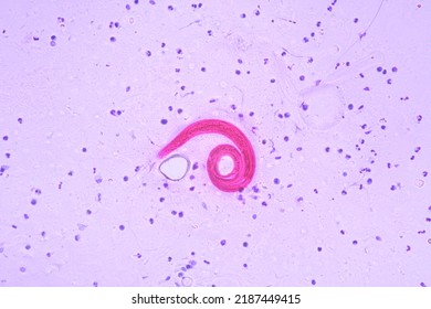 View In Microscopic Strongyloides Stercoralis Or Threadworm In Human Stool.Parasite Infection.Medical Background Analyze By Microscope, Original Magnification 400x